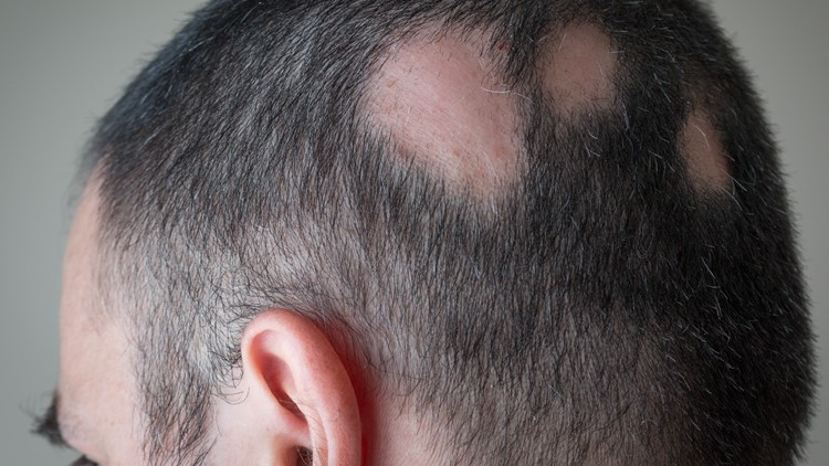 Drug to treat severe alopecia approved by FDA after 'milestone' results
