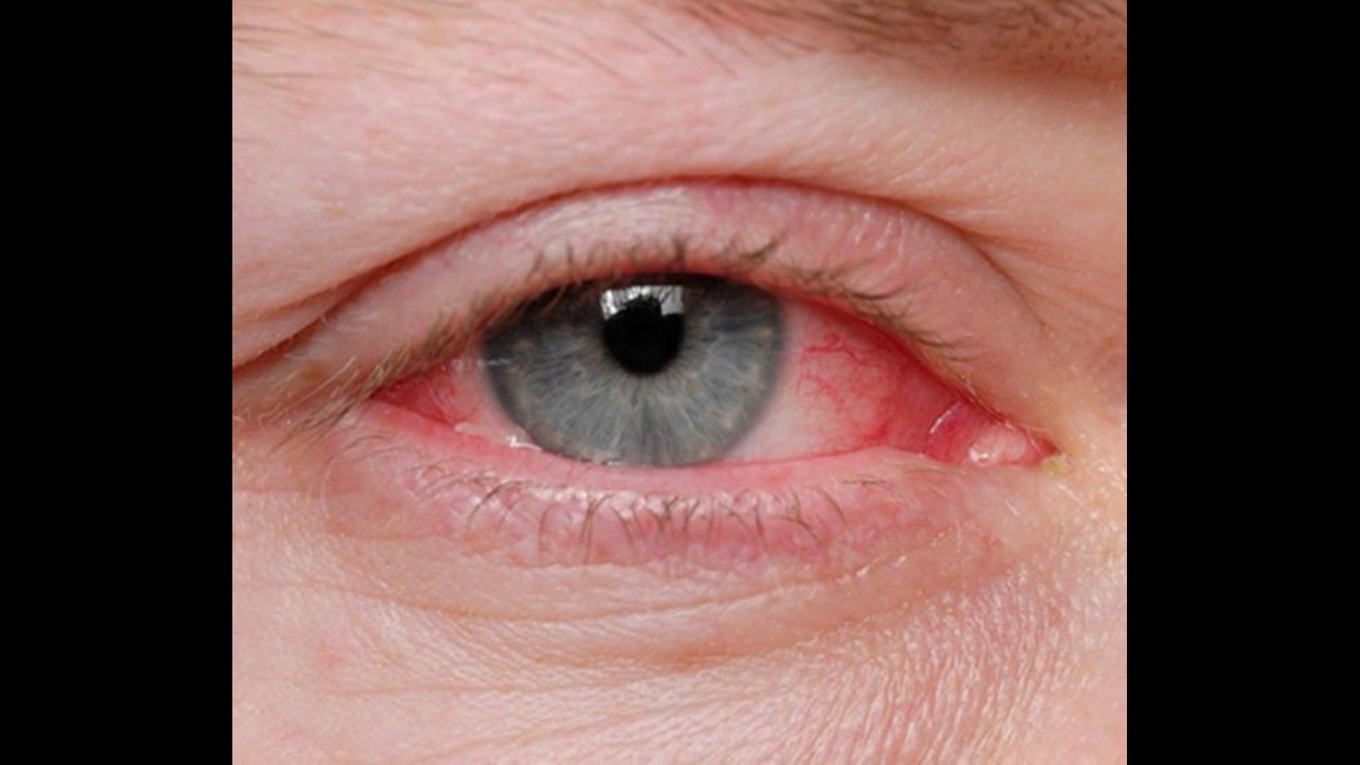 Keeping an eye out for different types of pink eye