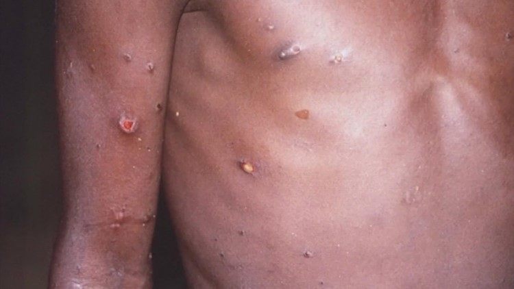 Ector County reports first case of monkeypox